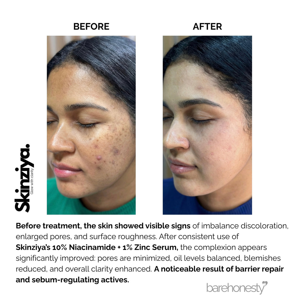 Skinziya 10% Niacinamide + 1% Zinc Serum – Oil Control & Pore Refining - Skinziya